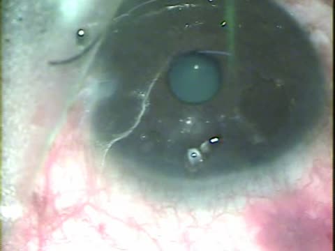 Stab Incision Glaucoma Surgery