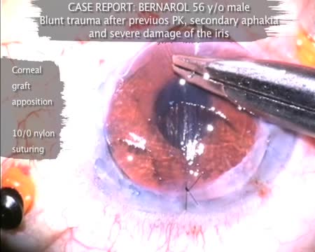 Surgical Techniques for Implanting an Artificial Iris