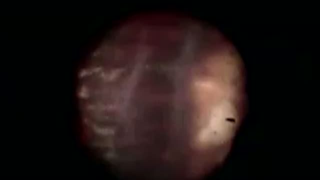Endoscopic PPV for Hypotony