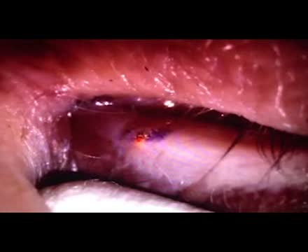Permanent Punctal Closure with the Slit-Lamp 532nm Diode Laser