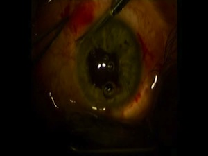 Pupillary Cerclage During Cataract Surgery to Repair a Permanently Dilated Pupil