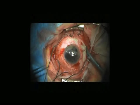 20-Gauge Vitrectomy Under Temporary Keratoprosthesis for Shattered Globe Reconstruction