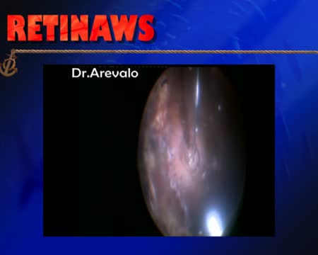 Interface Vitrectomy