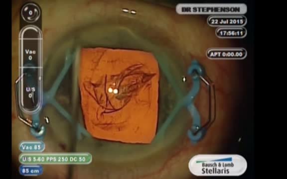 APX 200 Pupil Expanding Device
