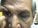 Coloboma