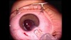 Monofocal Piggyback Sulcoflex IOL in Pediatric Case