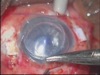Intralase DSEK with Glued IOL