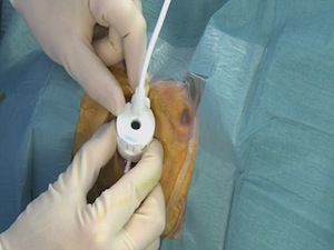 UC3, Ultrasound Circular Cyclo coagulation, a new method for treating glaucoma with High Intensity Focused Ultrasound