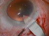 Clear Lensectomy: Hyperopia