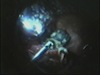 Hypotony During IOFB Removal