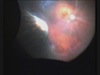 Buckling Surgery Using Chandelier Illumination