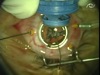 Volk Mini Quad Vit ACS