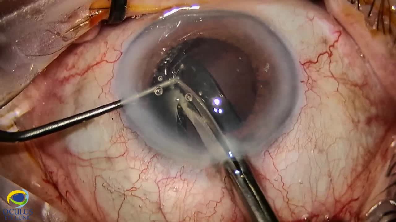 Opacified IOL Explantation