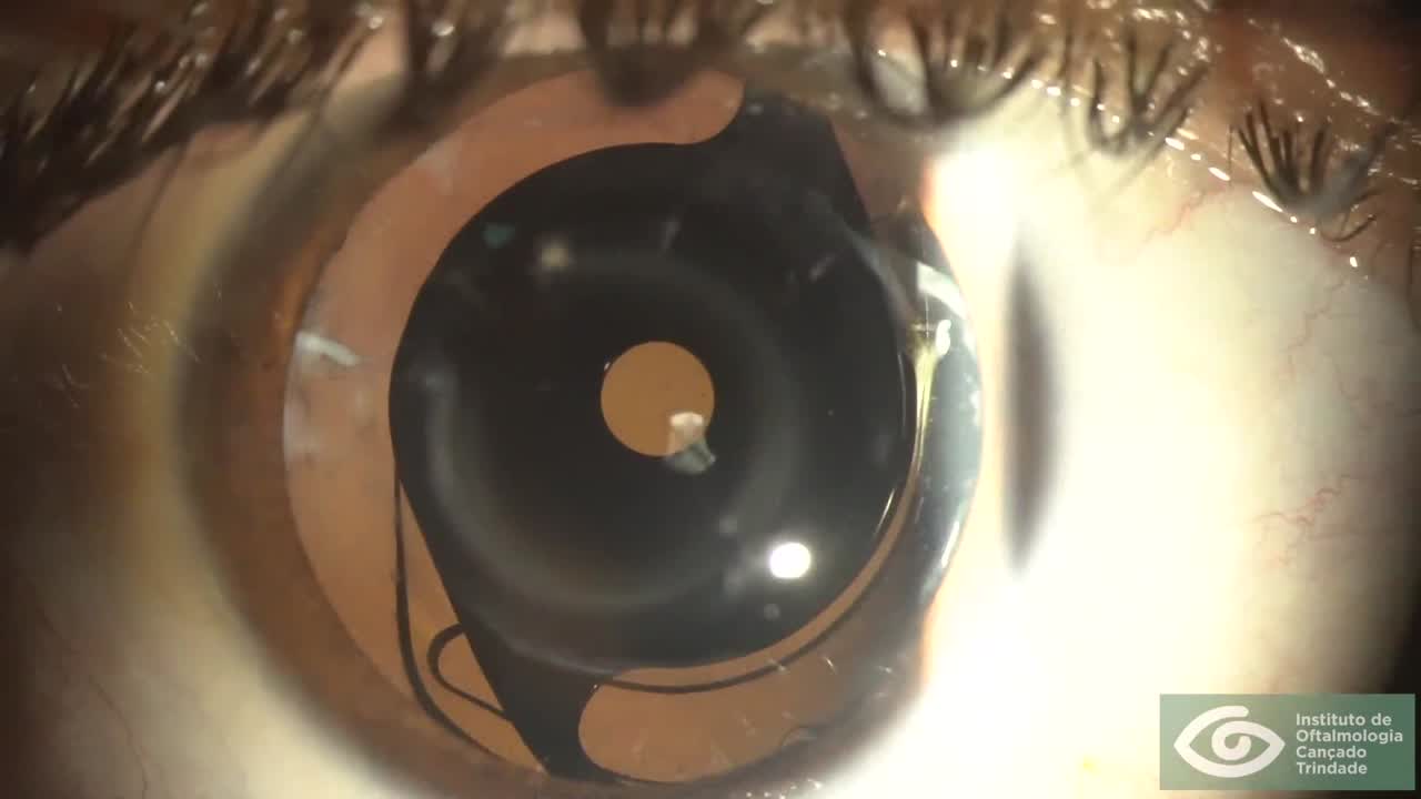IOL and Primary Pinhole Implant for Keratoconus