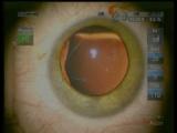 Surgery in a Patient With Marfans Syndrome