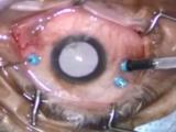 25-gauge Vitrectomy for Macular Hole Demonstrating ILM Peeling using Triesence Enhancement