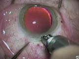 Making Scleral Grooved Incisions with a Diamond Knife