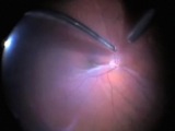 Induction of PVD
