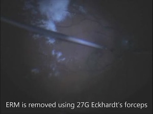 27 G Vitrectomy for Epiretinal Membrane Peeling