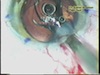 Piggyback with AcrySof IQ ReSTOR Multifocal Toric IOL and Monofocal Lens