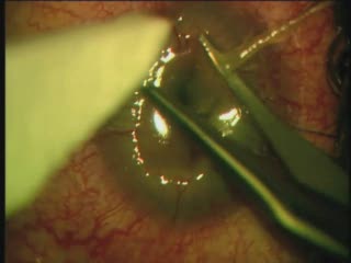 Penetrating Keratoplasty Management of a Large Spontaneous Corneal Perforation with Extrusion of Lens and Vitreous