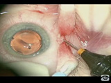 23G Vitrectomy for Macular Pucker