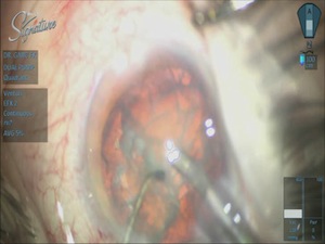 Tips and Tricks for Phaco Using the Whitestar Signature