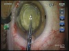 Catalys Femto Phaco With Arcuate Incisions