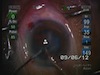 Eye Movement and Perforated LRI