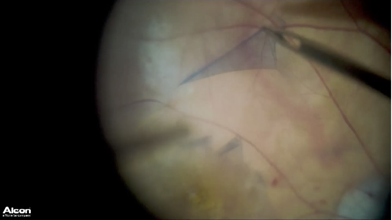 PVD in Myopic Eye