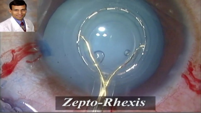 Zepto Cataract Surgery and Premium IOLs Implantation in Challenging Cases