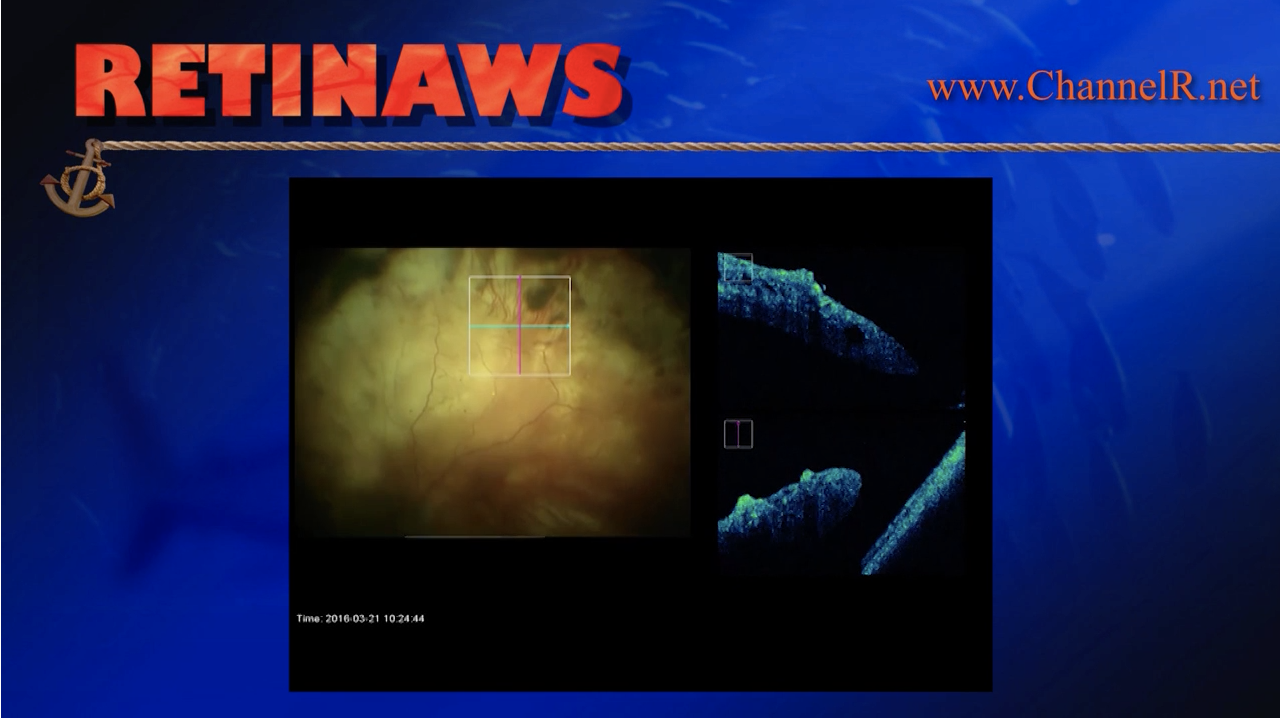 Retinal Detachment