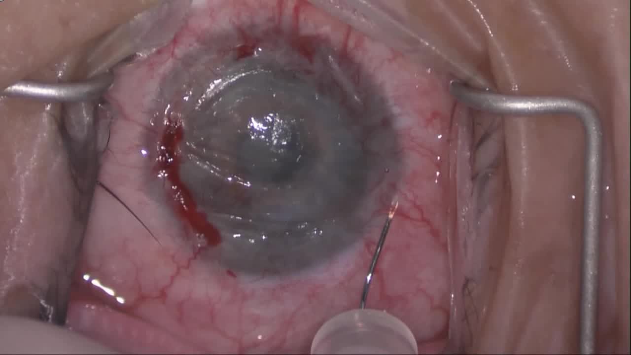 Fine Needle Diathermy Occlusion of Corneal Vessels with Adjunct Anti-VEGF Injections