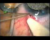 Thorn Injury Trauma Glue Boy