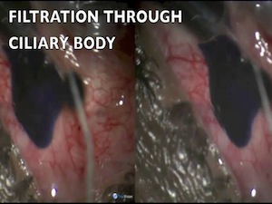 Transciliary Filtration in a Case of Keratoprosthesis