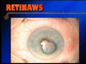 Cataract and Silicone Oil