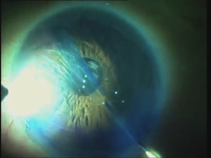 E-DMEK Fuch's Dystrophy with Cataract
