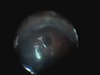 Repair of Phakic GRT