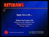 Optic Nerve Pit