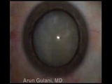 Complex Cataracts