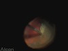 Vitreous Hemorrage...