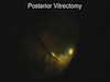  New Vitrectomy for Dense 18 Month Old Diabetic Vitreous Hemorrhage - 25 Gauge