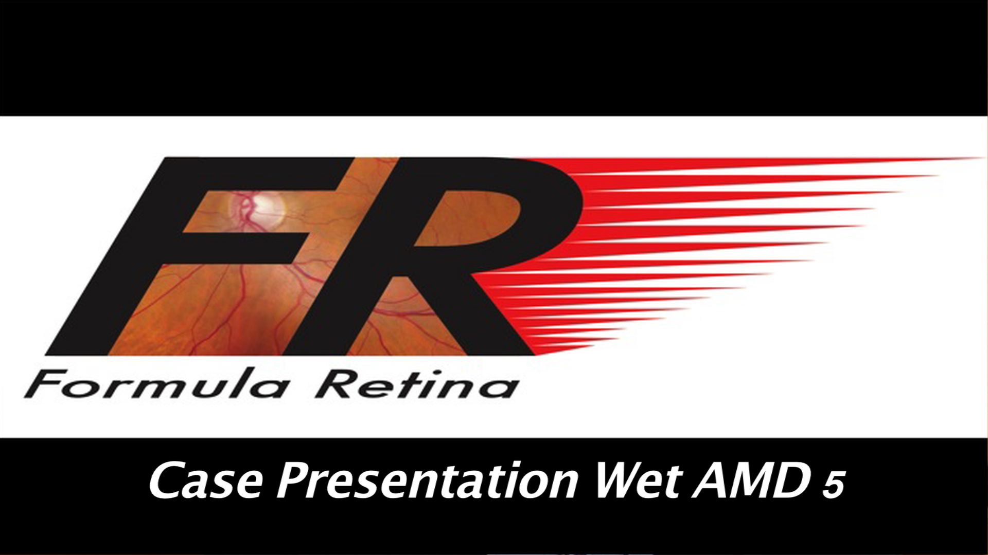 Case Presentation Wet AMD