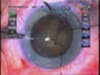 Intraoperative Zonular Disaster - Surgical Management of a Complicated Case