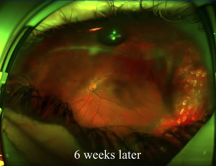 Retinal Fold