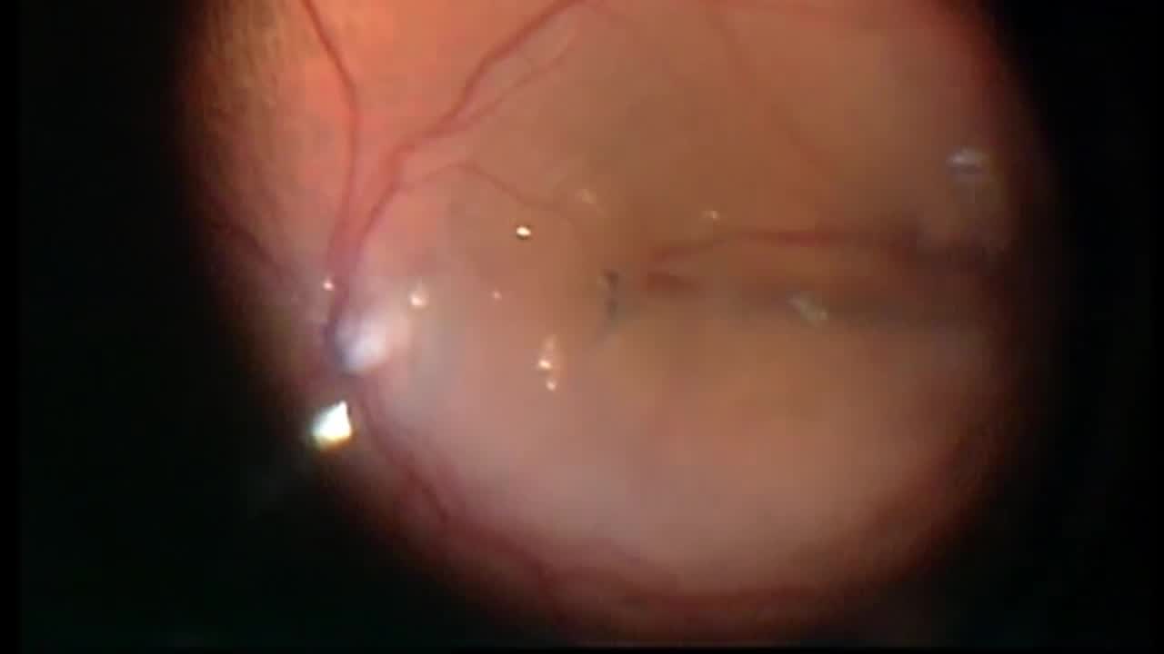 ILM Peel in Retinal Detachment