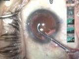 Penetrating LRI in Floppy Iris Case