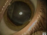Surgery of the loose cataract