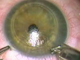 Myopic Keratomileusis of Barraquer and Astigmatic Keratotomy