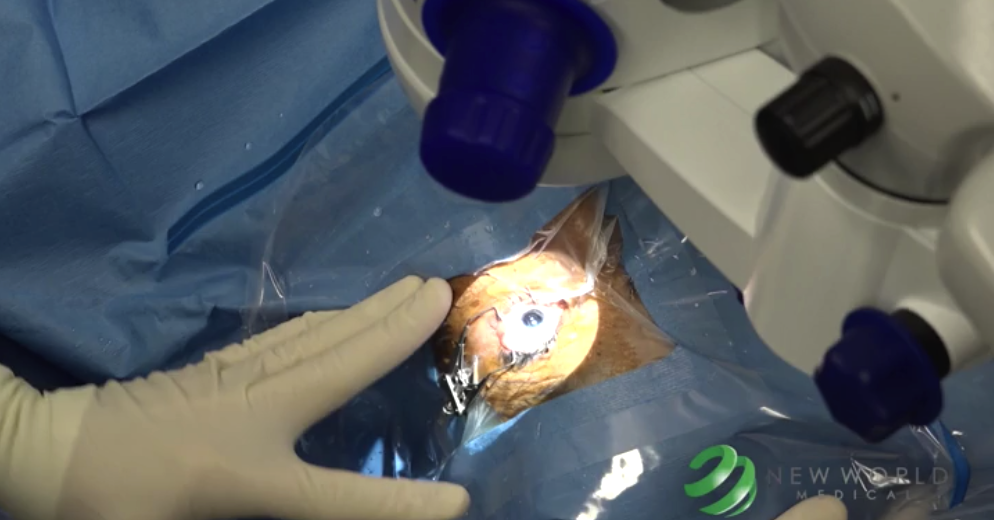 TM Removal with the Kahook Dual Blade – Surgical Technique